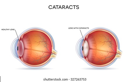 Cataracts And Healthy Eye Detailed Structure. 