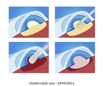 Cataracts surgery vector / eye
