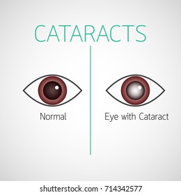 Cataracts Vector Icon Illustration