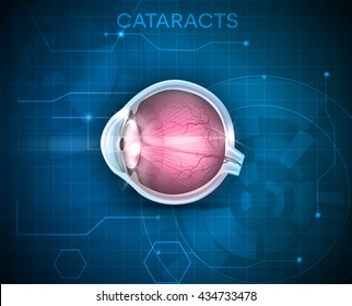 Cataracts, vision disorder, detailed anatomy on a blue technology background