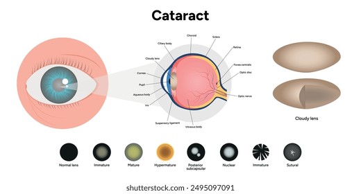 Cataracts Vision Disorder eye disease diagram with cloudy lens with zoom eye