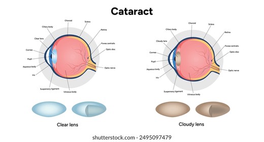 Cataracts Vision Disorder eye disease and Normal Eye Vision Anatomy diagram with cloudy and clear lens