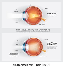 Cataracts Vision Disorder and Normal Eye Vision Anatomy Vector illustration