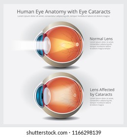 Cataracts Vision Disorder and Normal Eye Vision Anatomy Vector illustration