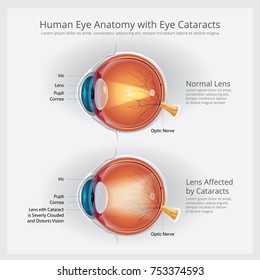 Catarata Distúrbio da Visão e Visão Normal Anatomia Ilustração vetorial