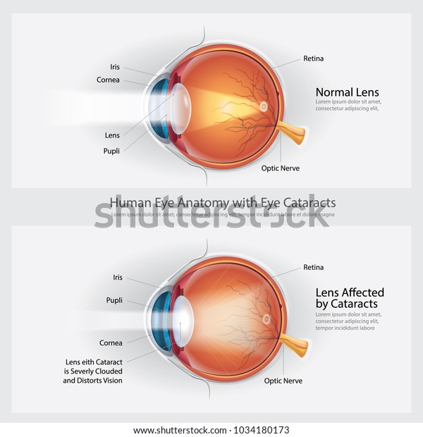 Cataracts Vision Disorder Normal Eye Vision Stock Vector (Royalty Free ...