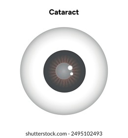 Cataracts vision disorder problem with blown eye 