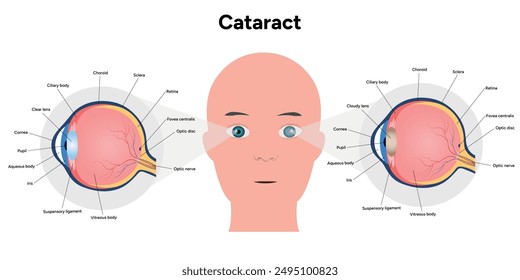 Cataracts vision disorder problem and normal eye vision human anatomy