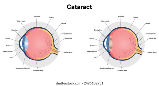 Cataracts vision disorder problem and normal eye vision human anatomy diagram