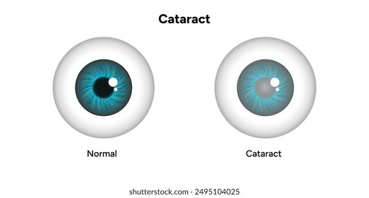 Cataracts vision disorder problem and normal eye vision human