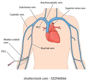 Catheter line (PICC) inserted into the superior vena cava from a peripheral vein in the arm.