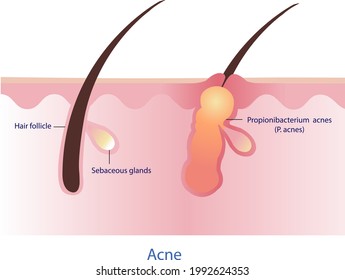 Cause of acne vector on white background.