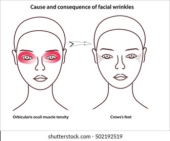 Cause and consequence of facial wrinkles. Crow'a feet in the eye area.  The scheme of young girl's face with stressed facial muscles. 