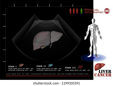 Cause of Liver disease infographic​