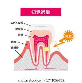 Cause and mechanism of Sensitive teeth vector illustration / translation: Enamel, Dentin, Pulp, Gum, Jaw bone, stimulus.