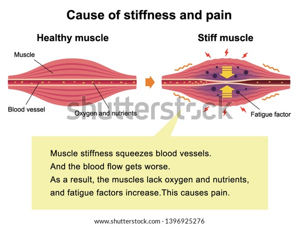 cause-muscles-stiffness-pain-illustration-explanation