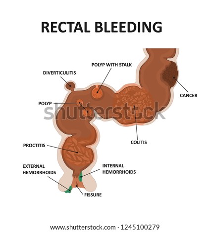 Cause rectal bleeding. Colitis, cancer, 
hemorrhoids, polyp, proctitis, diverticulitis