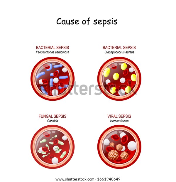 Cause Sepsis Fungal Candida Viral Herpes Stock Vector (Royalty Free ...