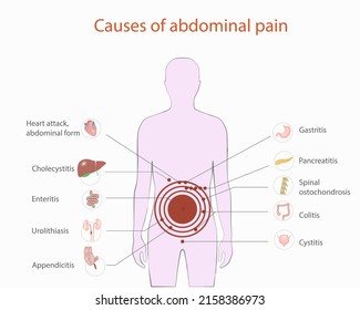 Causes Abdominal Pain Vector Medical Diagram Stock Vector (royalty Free 