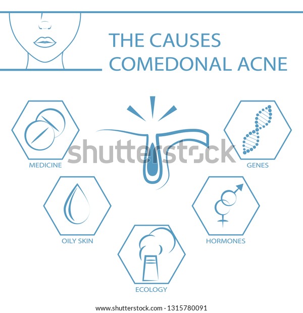Causes Acne Dermatology Skin Problems Comedonal Stock Vector