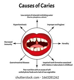Causes of caries. Smell from the mouth. Halitosis. The structure of the teeth and oral cavity. Diseases of the teeth. Infographics. Vector illustration on isolated background.