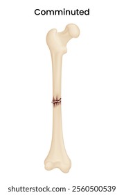Causes of the Comminuted Fracture