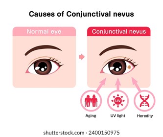 Causes of Conjunctival nevus vector illustration