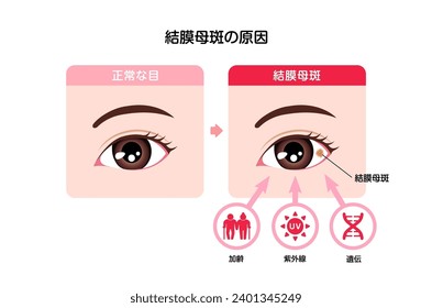 Causes of Conjunctival nevus vector illustration. Translation: Normal eye, Conjunctival nevus, stain on the eyeball, aging, UV, genetic factors.