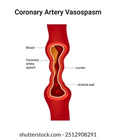 Causes of Coronary Artery Vasospasm