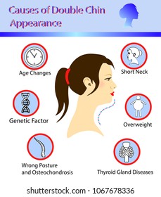 Causes of double chin