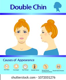 Causes of double chin, vector illustration diagram