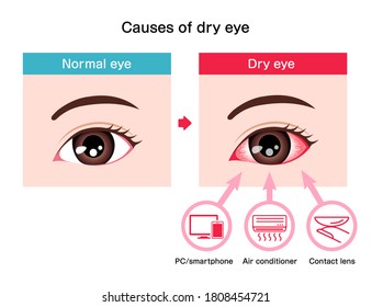 Causes of dry eye vector illustration