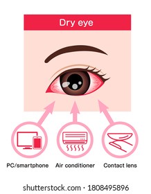 Causes Of Dry Eye Vector Illustration