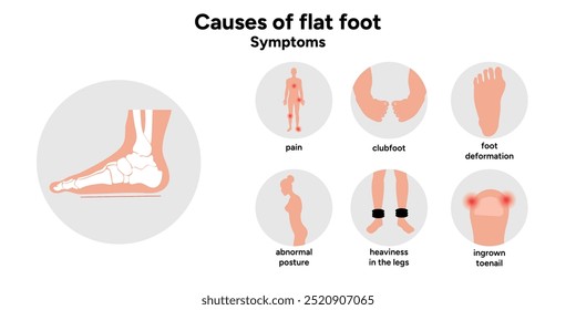 Causes of flat foot. Foot deformation 