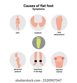 Causas del pie plano. Deformación del pie. Síntomas 