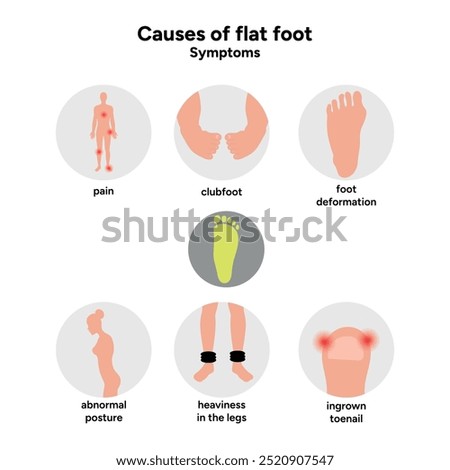 Causes of flat foot. Foot deformation. Symptoms 