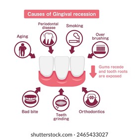 Causes of gingival recession. Vector illustration.