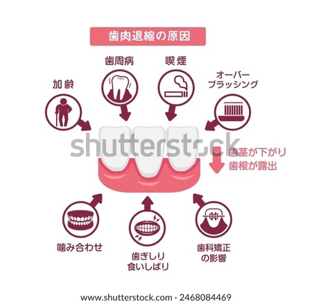 Causes of gingival recession. Vector illustration. Translation:  Causes of Gingival recession, Aging, Periodontal disease, Smoking, Over brushing, Bad bite, Teeth grinding, Orthodontics.