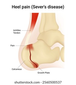 Causes of Heel Pain (Severs Disease)