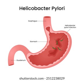 Causas da infecção por Helicobacter Pylori