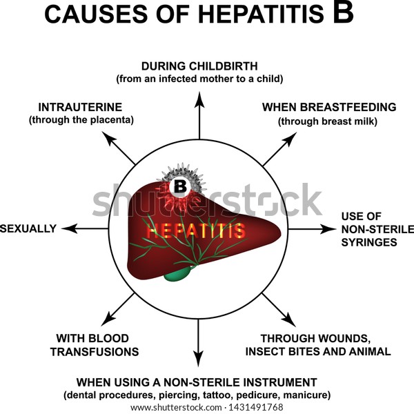 Causes Hepatitis B World Hepatitis Day Stock Vector (Royalty Free ...