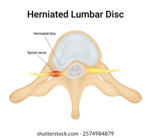 Causes of Herniated Lumbar Disc