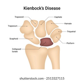 Causas de la enfermedad de Kienbock