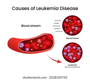 Causes of the Leukemia Disease