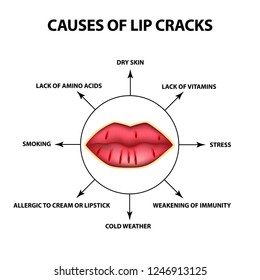 Causes of lip cracks. Cracks in the corners of the mouth. Infographics. Vector illustration on isolated background.