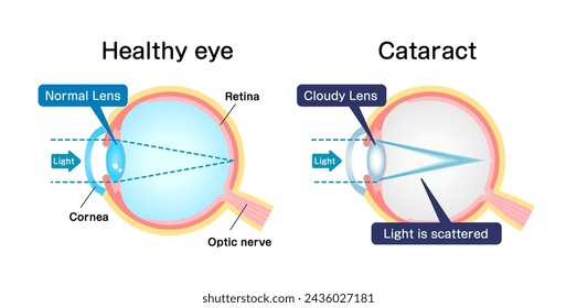 Ursachen und Mechanismus der Katarakt-Vektor-Illustration