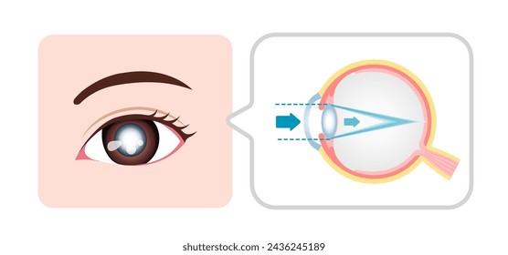 Ursachen und Mechanismus der Katarakt-Vektor-Illustration