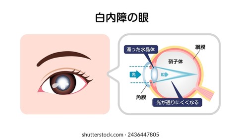 Causes and mechanism of cataract vector illustration. Translation:  Cataract, Normal Lens, Light, Cornea, Retina, Cloudy Lens, Light is scattered.