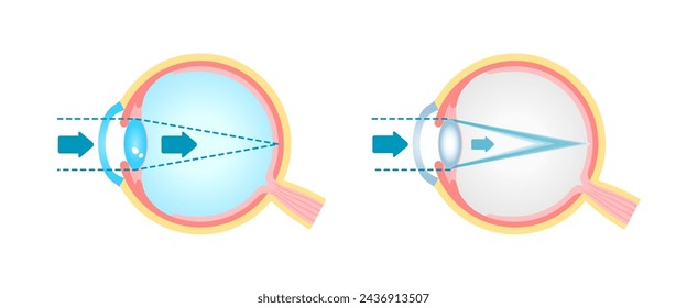 Causes and mechanism of cataract vector illustration