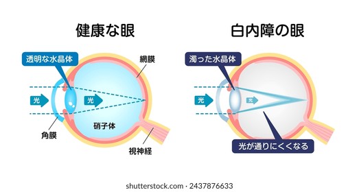 Causes and mechanism of cataract vector illustration. Translation: Normal eye, Cataract, Normal Lens, Light, Cornea, Retina, Cloudy Lens, Light is scattered.